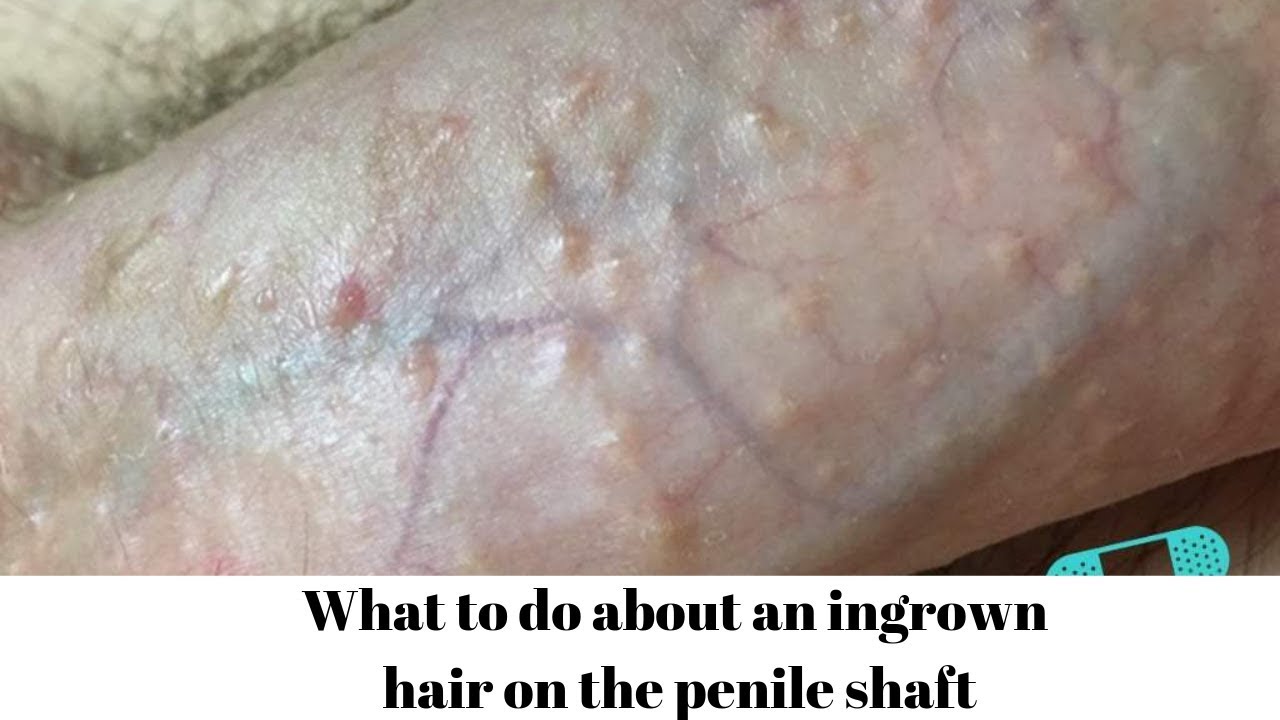 antoine antoun recommends Ingrown Hair On The Penile Shaft