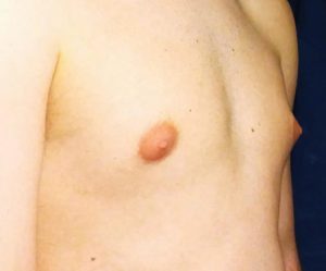 how to hide puffy nipples male