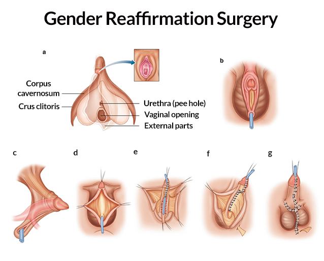 Best of Post op trans peeing