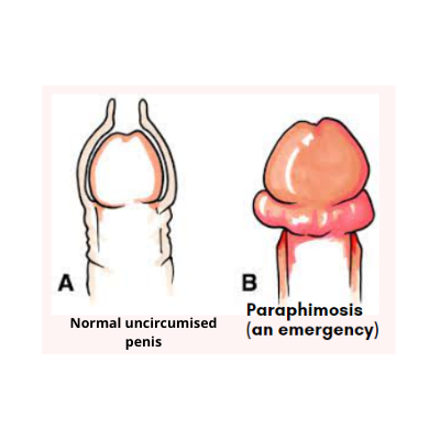 Uncircumcised Penis Photo a chalon