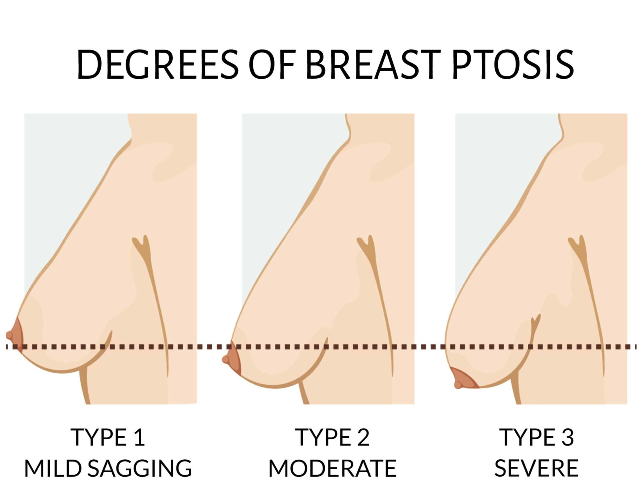 pictures of saggy breast