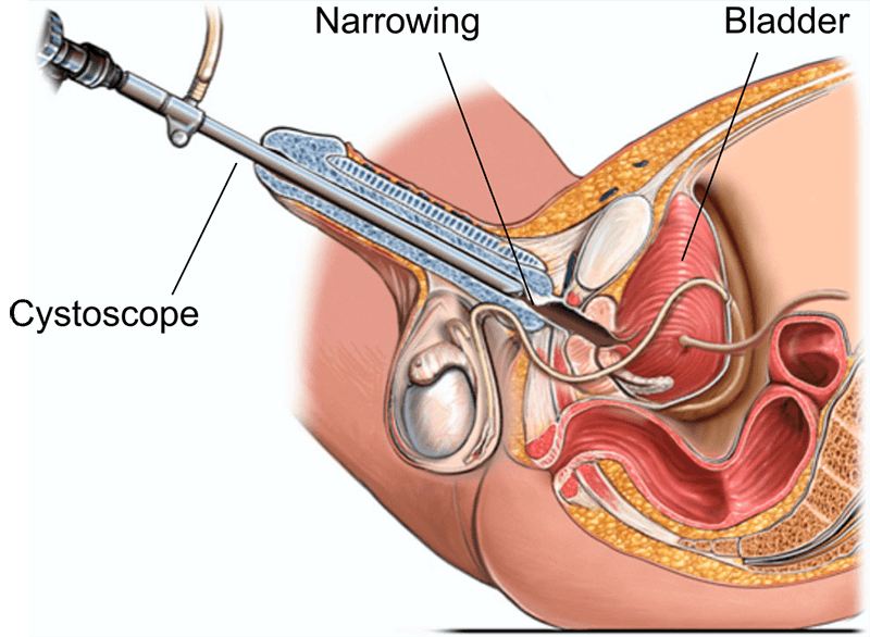 alice carruthers recommends sticking things in urethra pic