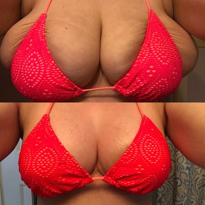 ashish kumbhare recommends What Do 34d Breast Look Like