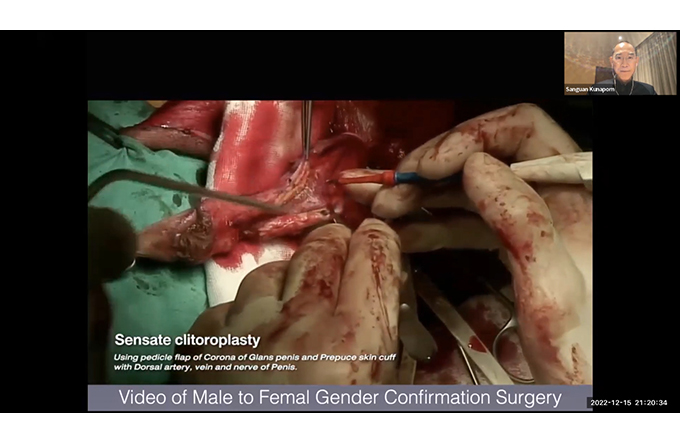 bobby ables recommends Female To Male Surgery Full Video