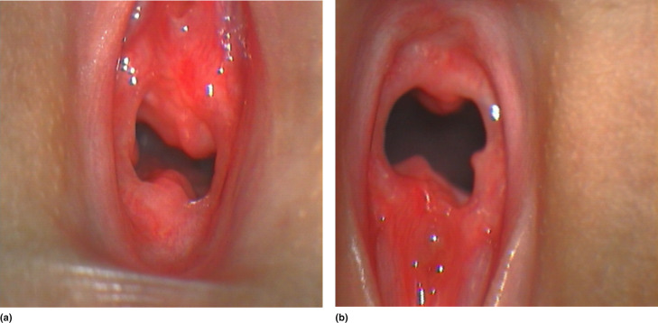 picture of hymen