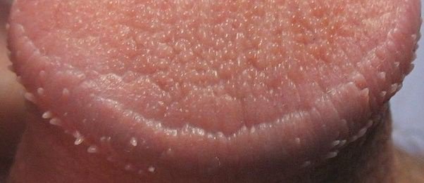 Best of Blackhead on penis head