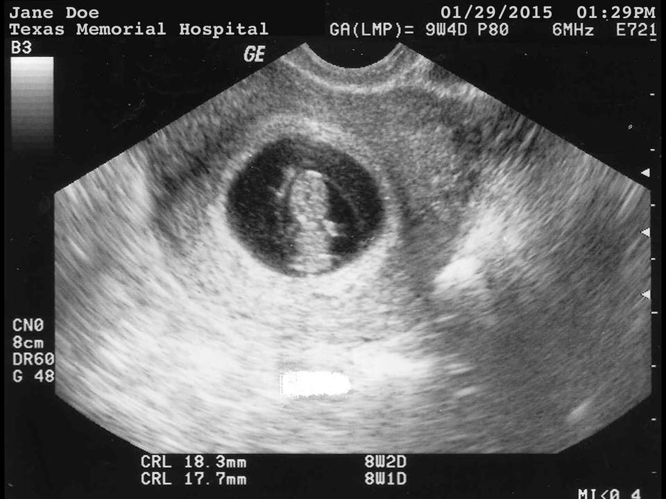 Best of Fake ultrasound pics free