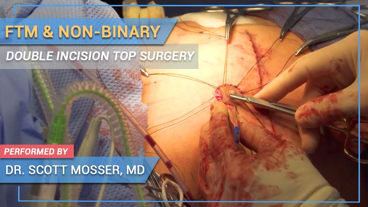 bret karlsen share female to male surgery full video photos