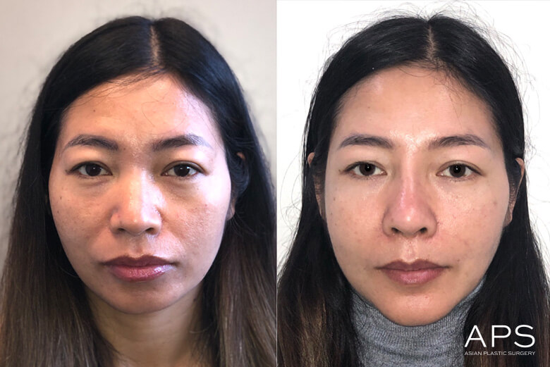 betty shaffer recommends asian facial pics pic