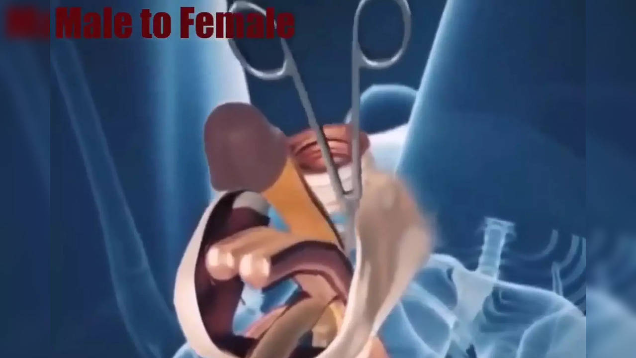 Best of Female to male surgery full video