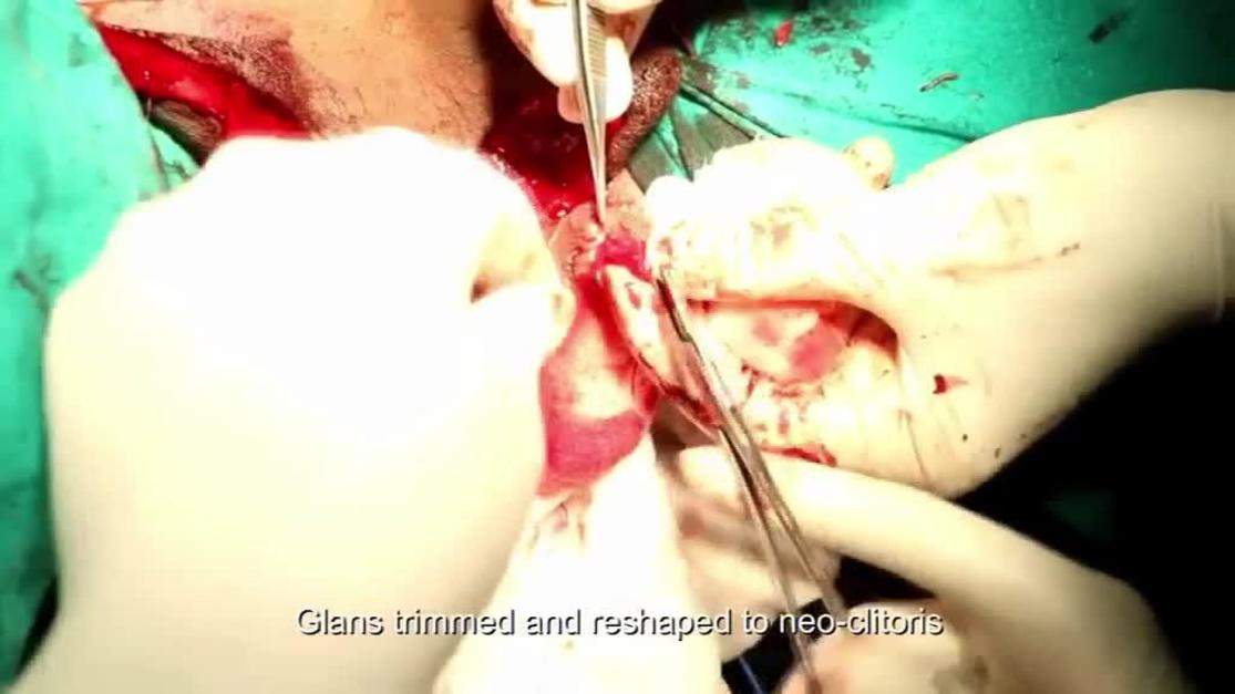 darren gannon add female to male surgery full video photo