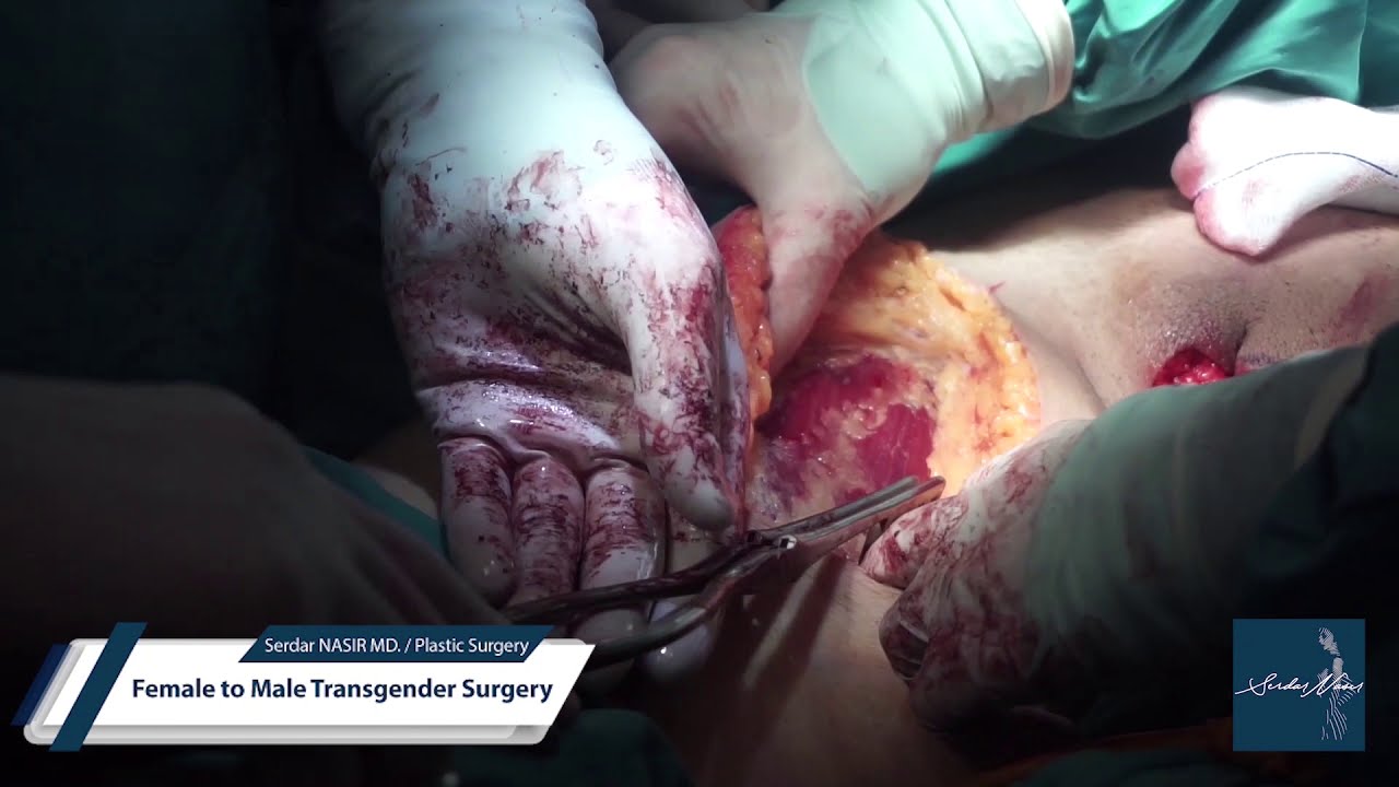 brenda rigor recommends female to male surgery full video pic