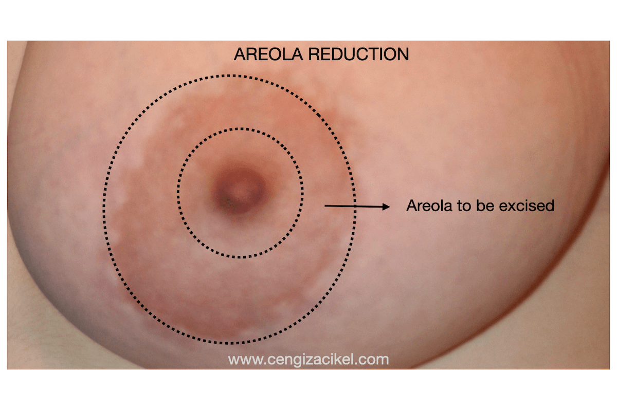 are large areolas normal