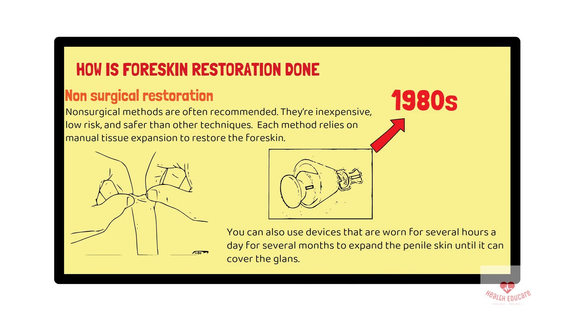 abo badawy add pictures of foreskin restoration photo