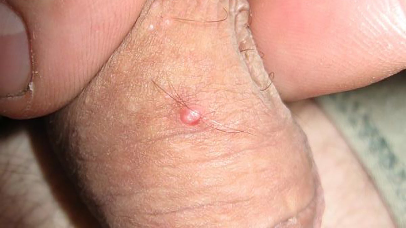 blair barwick recommends friction burn on penile pic