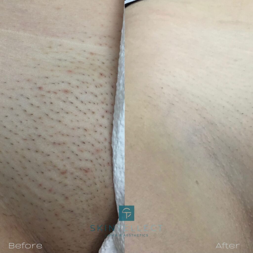 cesar collazos recommends Laser Hair Removal Pussy