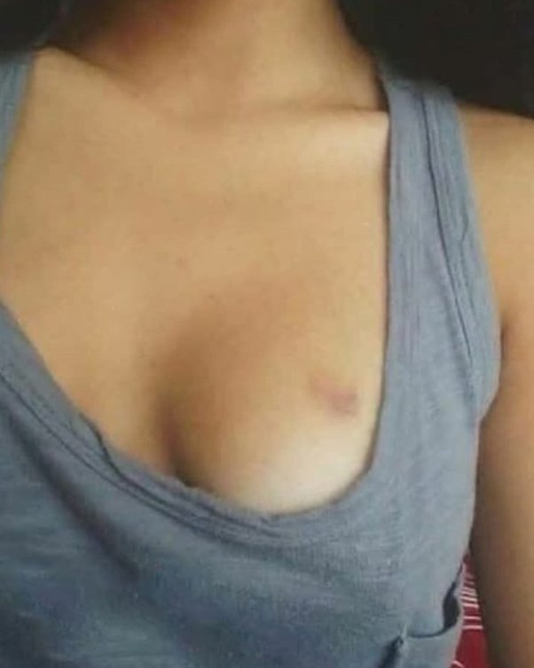 cindy thermidor add love bite on breast photo