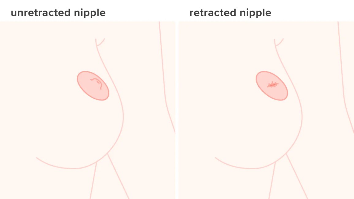 nipple sinks in when lying down