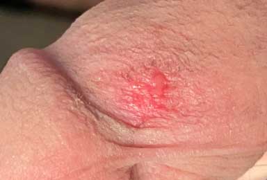 Penis Head Friction Burn mit penis