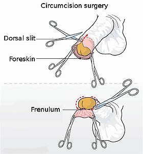 dhiraj wankhede recommends pictures of circumcised pic